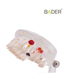 Modelo dental transparente caries