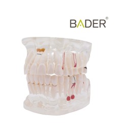 Modelo dental transparente con implante BADER® DENTAL